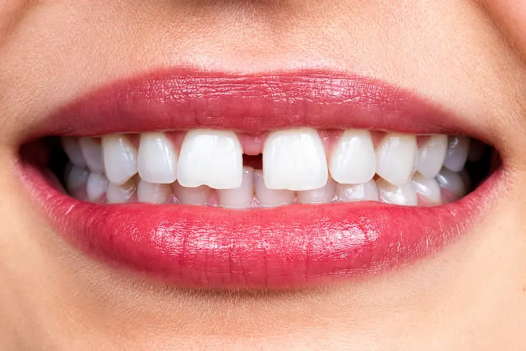 HOW DO VENEERS FOR GAP TEETH WORK?